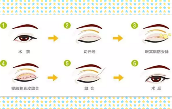 肿泡眼能埋线双眼皮吗 肿泡眼可以埋线吗