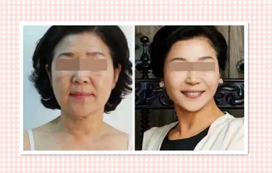 埋线提升面部适合年纪 埋线提升适合多大年龄