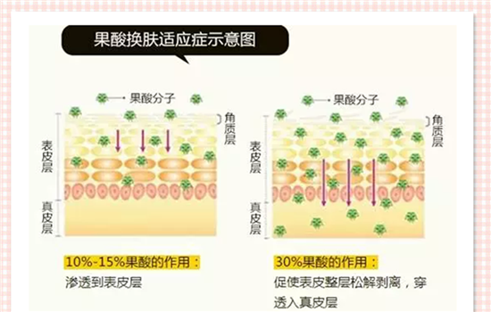 果酸换肤疼吗 果酸换肤疼不疼