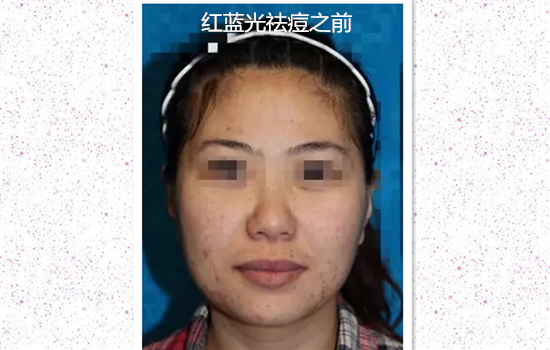 红蓝光治疗痤疮效果 红蓝光祛痘效果好吗