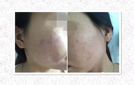 红蓝光治疗痤疮效果 红蓝光祛痘效果好吗
