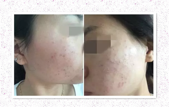 红蓝光治疗痤疮效果 红蓝光祛痘效果好吗