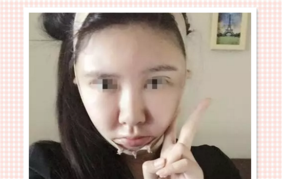 面部吸脂恢复过程图 面部抽脂恢复过程图片