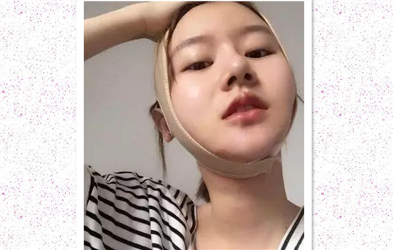 面部吸脂恢复过程图 面部抽脂恢复过程图片