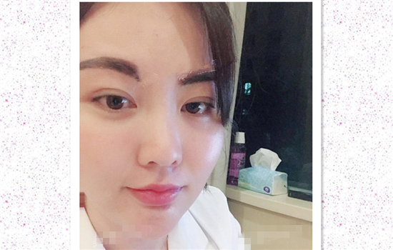 面部吸脂真实案例 脸部吸脂真实记录日记