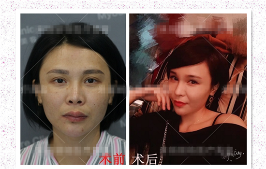 硅胶隆鼻失败案例 硅胶隆鼻失败图片