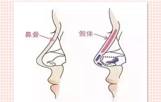 假体隆鼻歪了怎么处理 假体隆鼻歪了怎么办