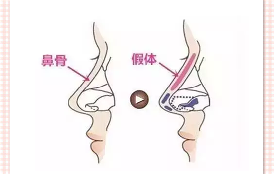 ​膨体隆鼻多久定型