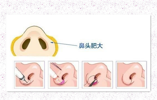 鼻翼缩小留疤后怎么去 鼻翼缩小增生怎么办
