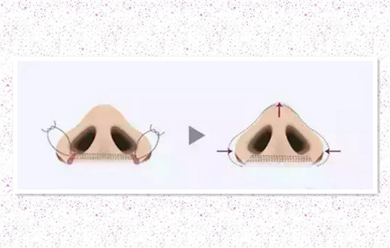 鼻翼缩小有几种方法 缩鼻翼怎么缩