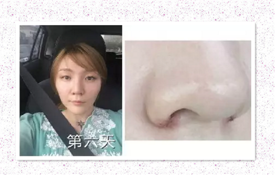 鼻翼缩小手术恢复过程图 鼻翼外切恢复过程图