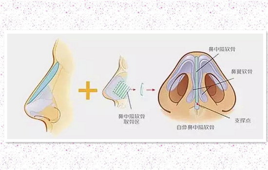 鼻小柱延长是永久的吗