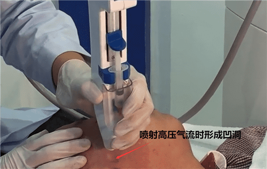 无针水光操作流程 无针水光操作图片