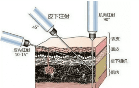 嗨体可以打泪沟吗 嗨体填充泪沟