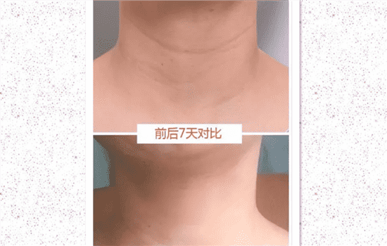 嗨体水光针有什么功效