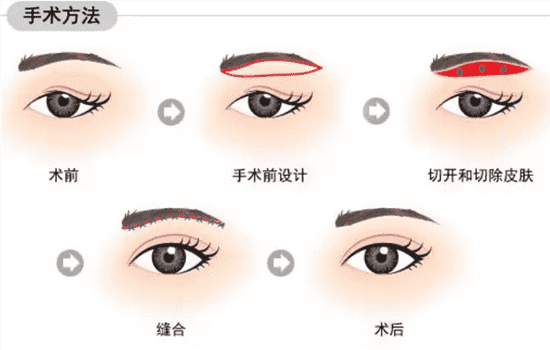 切眉手术几天拆线 切眉几天拆线好