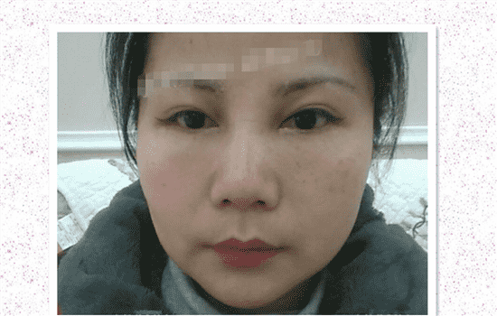 切眉手术恢复过程图 提眉术后全过程照片