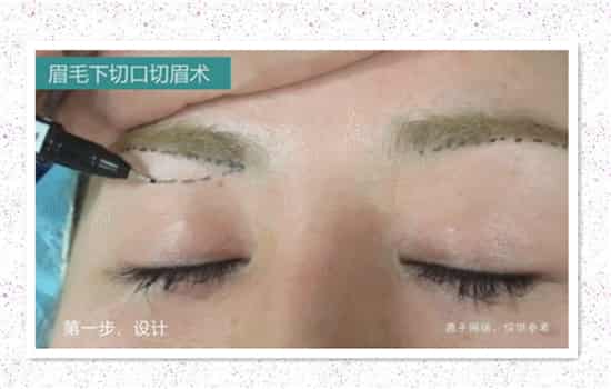 眉下切口提升图