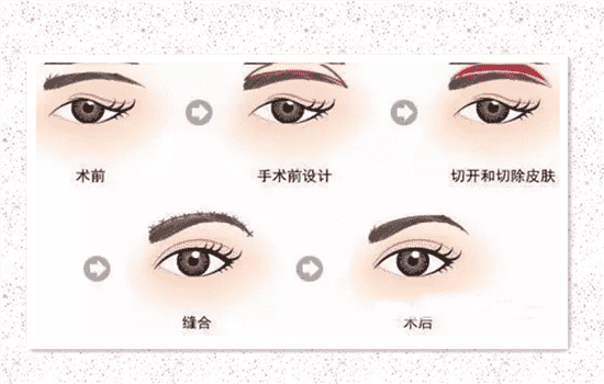 眉上切口提眉图片