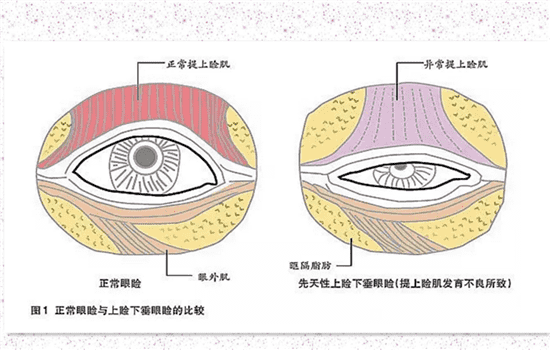 上睑提肌后是永久的吗 双眼皮提肌是永久的吗