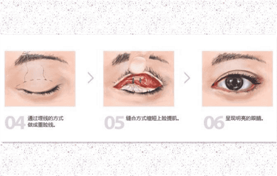 上睑提肌缩短术后悔了 做了上睑提肌眼睛瞪人
