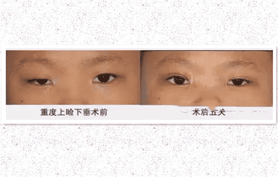 上睑下垂做什么手术 上睑下垂哪种手术方法