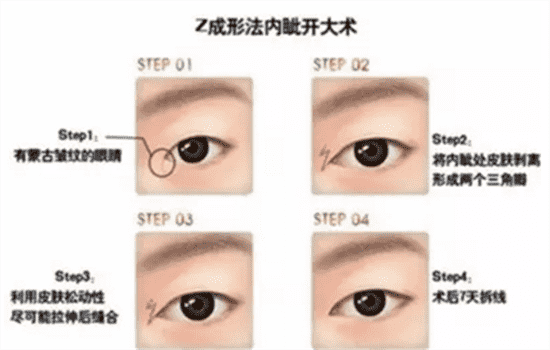 开内眼角有几种方法 开前眼角怎么开的