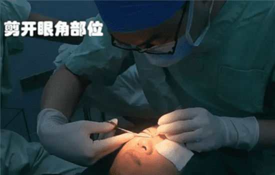 开内眼角手术过程 开内眼角怎么开