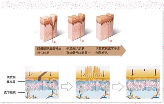 激光去痘印的坏处