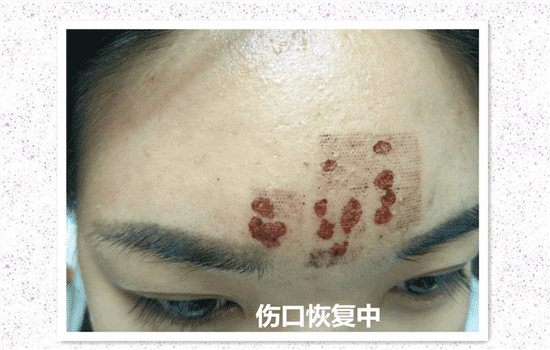 激光去痘印会留疤吗 激光祛痘印会留疤吗