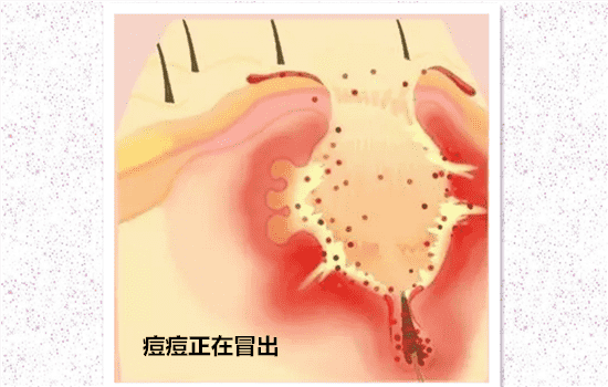激光去痘印过程 激光去痘印怎么去