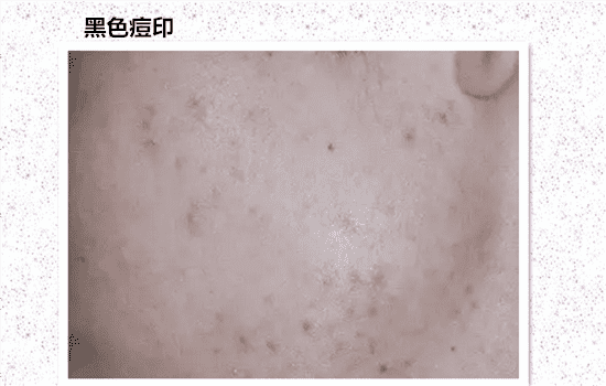 激光祛痘印有风险吗 激光去痘印危险吗