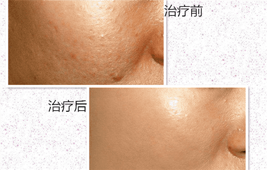 用激光去痘印好吗 激光去痘印到底好不好