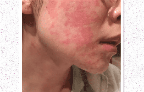 打完水光针几天能化妆 水光针后几天可以化妆