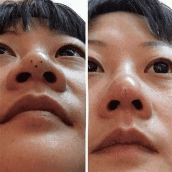 线雕隆鼻需要几根线 线雕隆鼻放几根线