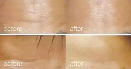 水光针怎样注射
