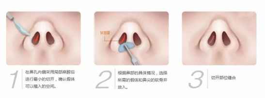 鼻子整形有几种方法