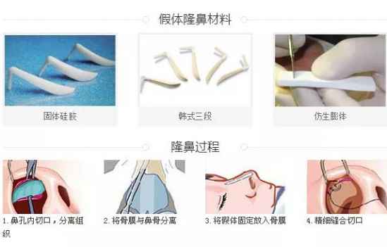 鼻子整形有几种方法