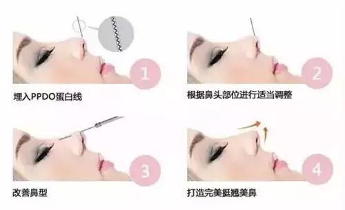 鼻子整形有几种方法