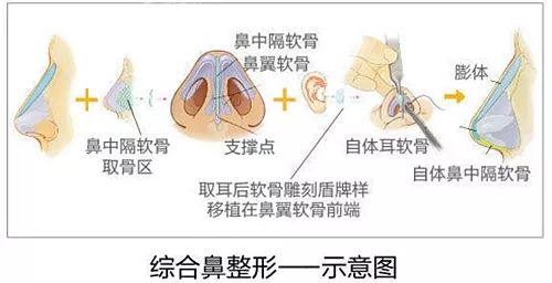 鼻子整形有几种方法