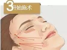 线雕是什么