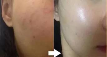 水光针副作用 水光针的作用