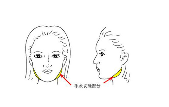 脸宽骨骼大怎么办 脸骨骼大怎么变小