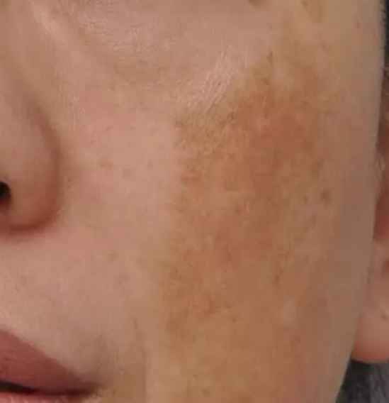 活性斑怎么去除 活性斑如何淡化